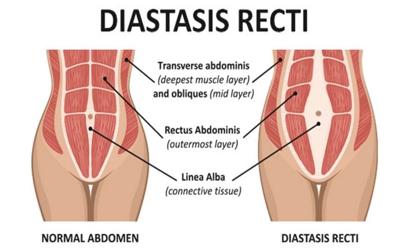 Understanding Diastasis Recti: AKA 